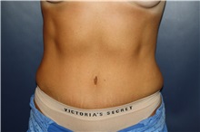 Tummy Tuck After Photo by Larry Weinstein, MD; Chester, NJ - Case 37536