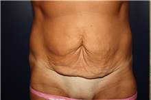 Tummy Tuck Before Photo by Larry Weinstein, MD; Chester, NJ - Case 37536