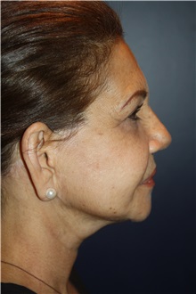 Neck Lift After Photo by Larry Weinstein, MD; Chester, NJ - Case 37540