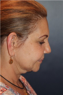 Neck Lift Before Photo by Larry Weinstein, MD; Chester, NJ - Case 37540