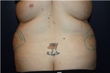 Body Contouring Before Photo by Larry Weinstein, MD; Chester, NJ - Case 37709