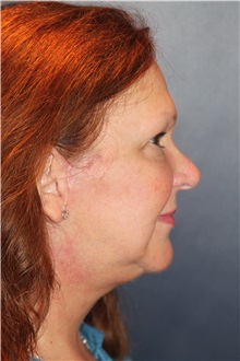 Neck Lift After Photo by Larry Weinstein, MD; Chester, NJ - Case 37712