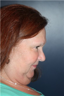 Neck Lift Before Photo by Larry Weinstein, MD; Chester, NJ - Case 37712