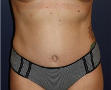 Tummy Tuck After Photo by Larry Weinstein, MD; Chester, NJ - Case 37981