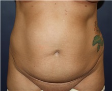 Tummy Tuck Before Photo by Larry Weinstein, MD; Chester, NJ - Case 37981