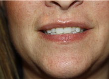 Lip Augmentation/Enhancement After Photo by Larry Weinstein, MD; Chester, NJ - Case 38227