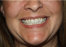 Lip Augmentation/Enhancement Before Photo by Larry Weinstein, MD; Chester, NJ - Case 38227