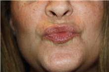 Lip Augmentation/Enhancement After Photo by Larry Weinstein, MD; Chester, NJ - Case 38227