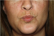 Lip Augmentation/Enhancement Before Photo by Larry Weinstein, MD; Chester, NJ - Case 38227