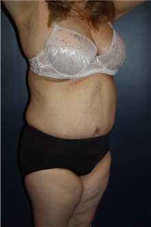 Tummy Tuck After Photo by Larry Weinstein, MD; Chester, NJ - Case 39354