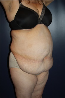 Tummy Tuck Before Photo by Larry Weinstein, MD; Chester, NJ - Case 39354