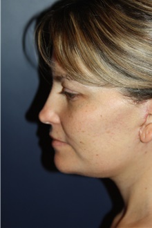 Neck Lift After Photo by Larry Weinstein, MD; Chester, NJ - Case 39572