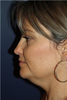 Neck Lift Before Photo by Larry Weinstein, MD; Chester, NJ - Case 39572