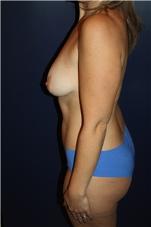 Breast Lift Before Photo by Larry Weinstein, MD; Chester, NJ - Case 39573