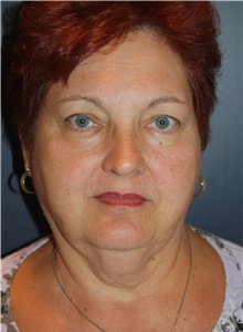 Neck Lift Before Photo by Larry Weinstein, MD; Chester, NJ - Case 39576