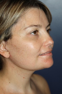 Neck Lift After Photo by Larry Weinstein, MD; Chester, NJ - Case 39963