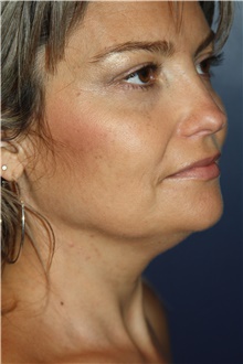 Neck Lift Before Photo by Larry Weinstein, MD; Chester, NJ - Case 39963