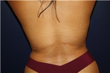 Body Contouring After Photo by Larry Weinstein, MD; Chester, NJ - Case 40902