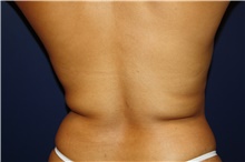 Body Contouring Before Photo by Larry Weinstein, MD; Chester, NJ - Case 40902