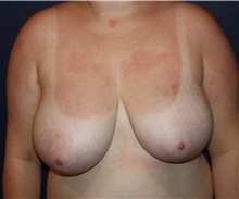 Breast Reduction Before Photo by Larry Weinstein, MD; Chester, NJ - Case 40903