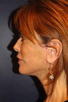 Facelift After Photo by Larry Weinstein, MD; Chester, NJ - Case 40906