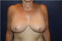 Breast Lift After Photo by Larry Weinstein, MD; Chester, NJ - Case 41224