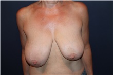 Breast Lift Before Photo by Larry Weinstein, MD; Chester, NJ - Case 41224
