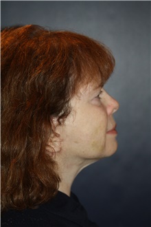 Facelift After Photo by Larry Weinstein, MD; Chester, NJ - Case 41238