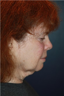 Facelift Before Photo by Larry Weinstein, MD; Chester, NJ - Case 41238