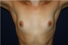 Breast Augmentation Before Photo by Larry Weinstein, MD; Chester, NJ - Case 41310