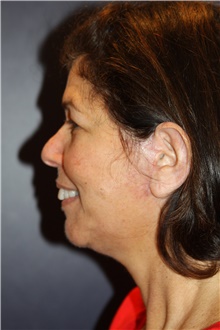 Neck Lift After Photo by Larry Weinstein, MD; Chester, NJ - Case 41600