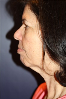 Neck Lift Before Photo by Larry Weinstein, MD; Chester, NJ - Case 41600