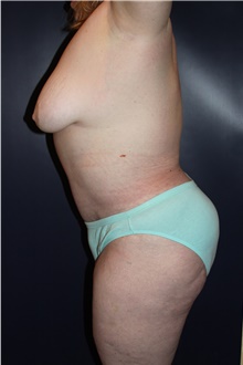 Body Contouring After Photo by Larry Weinstein, MD; Chester, NJ - Case 41604