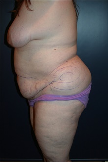 Body Contouring Before Photo by Larry Weinstein, MD; Chester, NJ - Case 41604