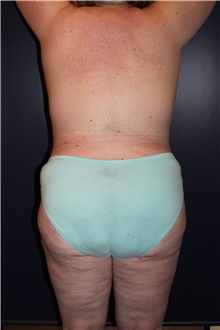 Liposuction After Photo by Larry Weinstein, MD; Chester, NJ - Case 41606