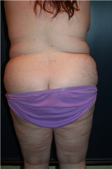 Liposuction Before Photo by Larry Weinstein, MD; Chester, NJ - Case 41606