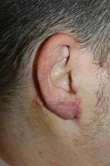 Ear Reconstruction Surgery After Photo by Larry Weinstein, MD; Chester, NJ - Case 41720