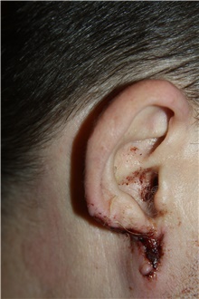 Ear Reconstruction Surgery Before Photo by Larry Weinstein, MD; Chester, NJ - Case 41720