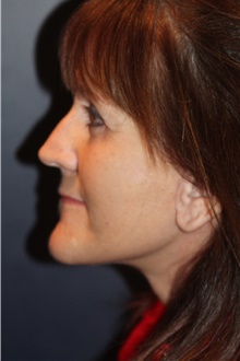 Facelift After Photo by Larry Weinstein, MD; Chester, NJ - Case 41722