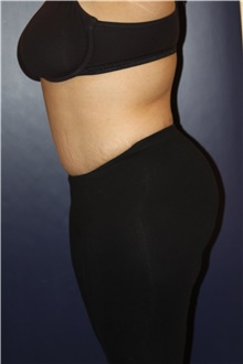 Tummy Tuck After Photo by Larry Weinstein, MD; Chester, NJ - Case 41809