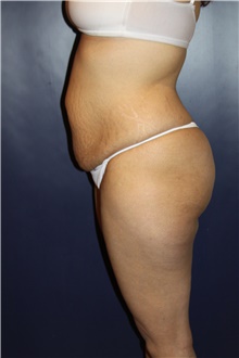 Tummy Tuck Before Photo by Larry Weinstein, MD; Chester, NJ - Case 41809