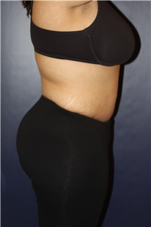 Tummy Tuck After Photo by Larry Weinstein, MD; Chester, NJ - Case 41809