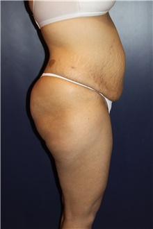 Tummy Tuck Before Photo by Larry Weinstein, MD; Chester, NJ - Case 41809