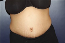 Tummy Tuck After Photo by Larry Weinstein, MD; Chester, NJ - Case 41809