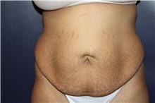 Tummy Tuck Before Photo by Larry Weinstein, MD; Chester, NJ - Case 41809