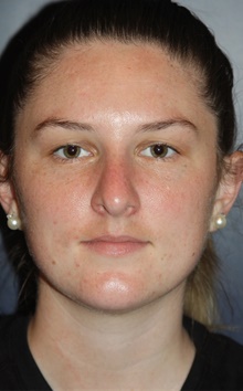 Rhinoplasty After Photo by Larry Weinstein, MD; Chester, NJ - Case 42063