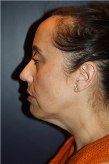 Facelift Before Photo by Larry Weinstein, MD; Chester, NJ - Case 42064