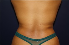 Liposuction After Photo by Larry Weinstein, MD; Chester, NJ - Case 42066