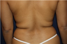 Liposuction Before Photo by Larry Weinstein, MD; Chester, NJ - Case 42066