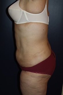 Body Contouring After Photo by Larry Weinstein, MD; Chester, NJ - Case 42092